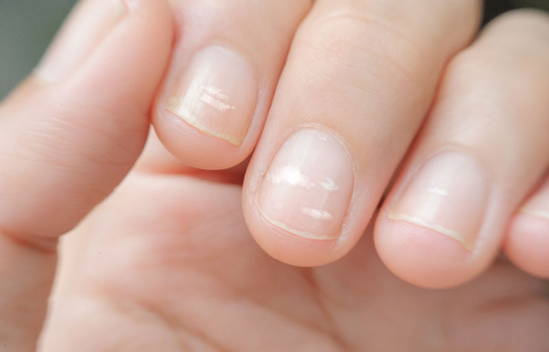 Eisenmangel erkennen: Fingernägel